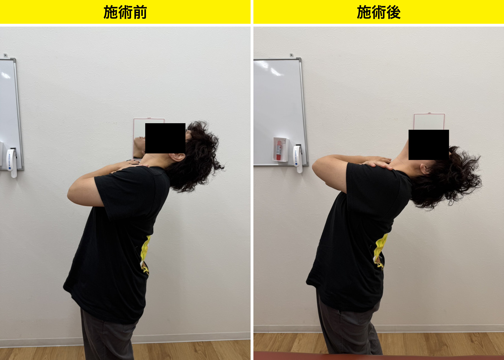 首を後ろに倒す動きの変化(施術前・施術後)