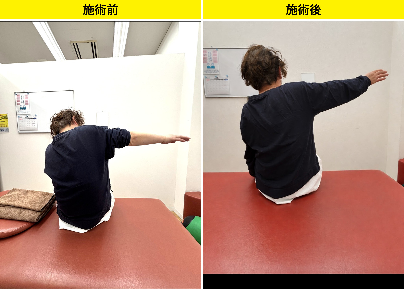 T様の施術前後の肩の高さの比較